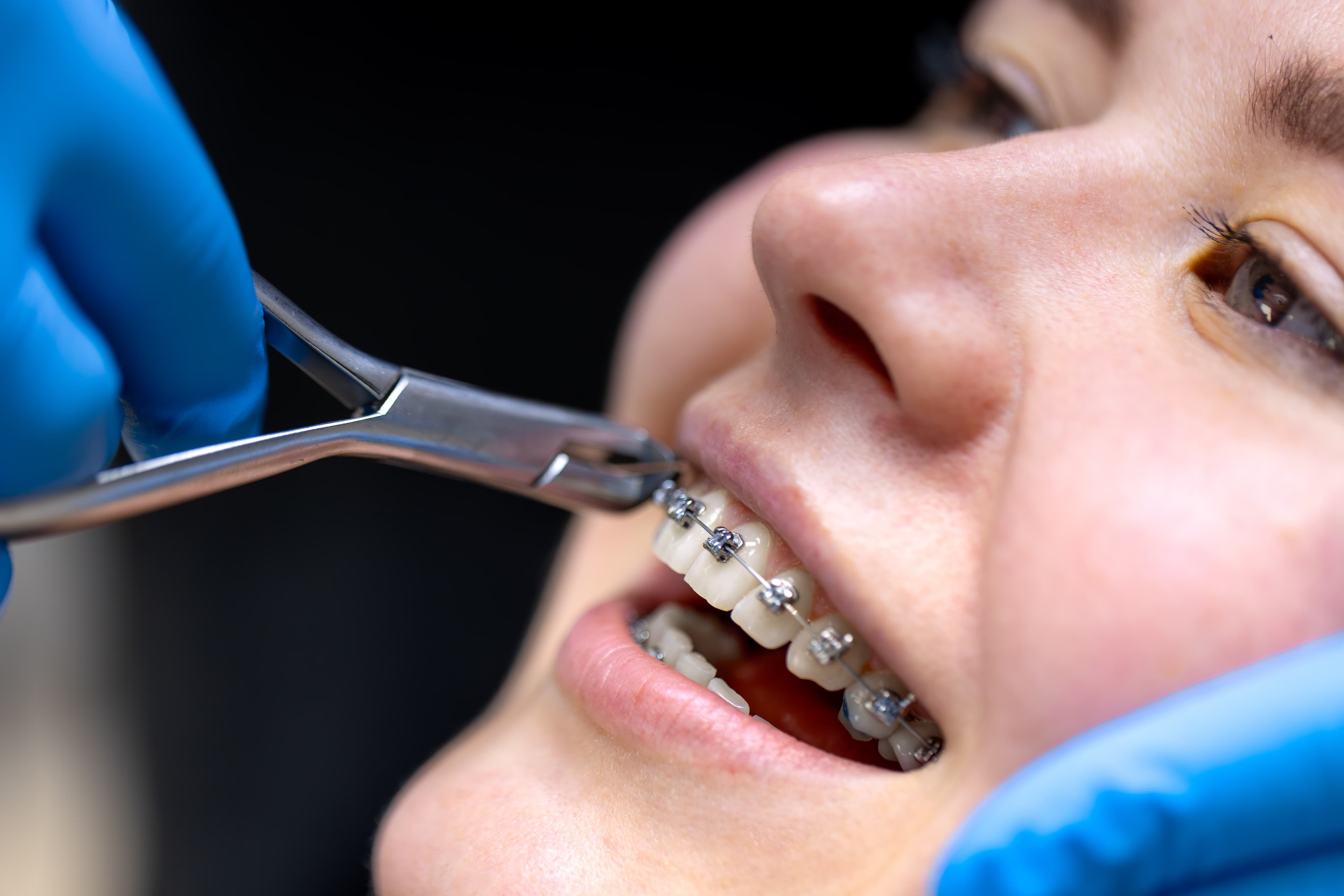 Orthodontics (Braces)